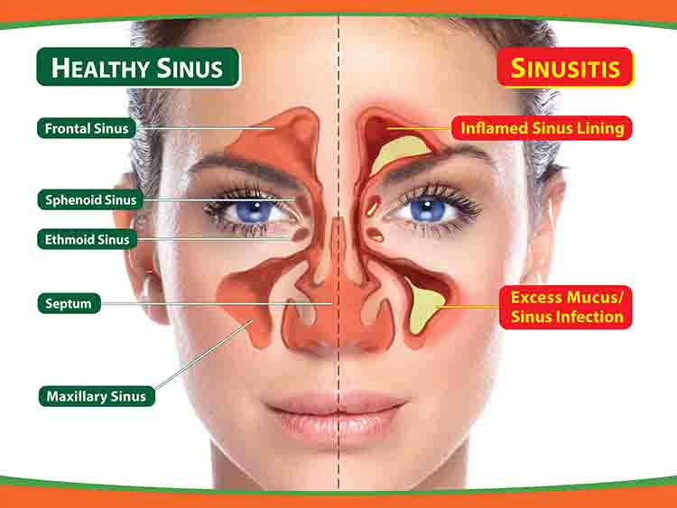 JosephEHolcomb3's tweet photo. How To Clear Seriously Blocked Sinuses Naturally In 1 Minute https://t.co/weGnceLMDE https://t.co/1yB8KldWiF