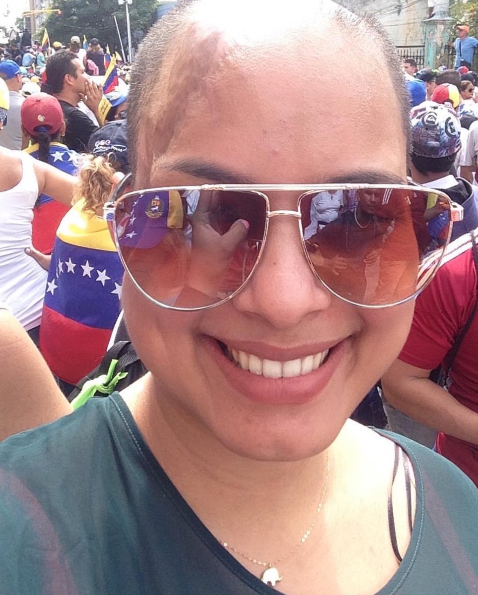 Miren a esta belleza que marchó hoy! Si,volvió a las calles después de haber sido arrollada y casi asesinada por el régimen.Casi 2 años después <a href="/WadskierOriana/">Oriana Wadskier 🇻🇪</a> regresó al asfalto , con su energía de siempre y con esa sonrisa que nadie pudo robarle.Te amo princesa de DIOS 💛💙♥️🇻🇪