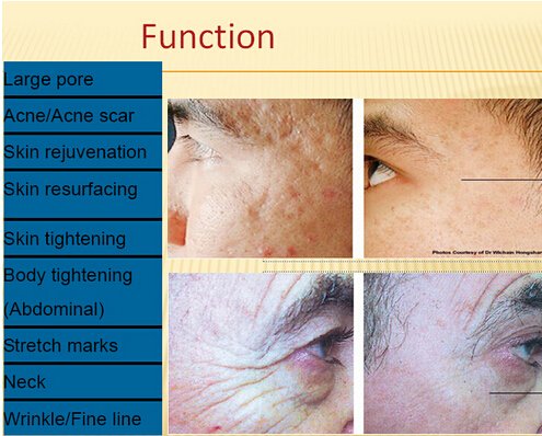 AmyGAO47491413's tweet image. #rfmachine
it can od
#Resurface the skin, which helps reduce the appearance of #acnescars and other #scars, striae, #rosacea, dyschromia, deep wrinkles, enlarged pores, and uneven skin texture and #pigmentation for all skin types

#Effective in improving skin texture and pigmenta