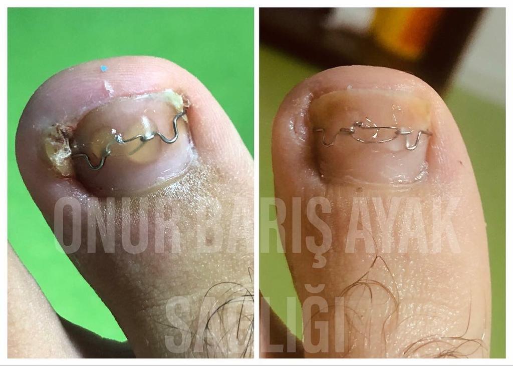 En güzeli de bana acılar içinde gelen ve podolojiyi tanımadığı için neler yapabileceğimi bilmeyen hastanın daha üçüncü seansta daha önce çektiği acıları unutturabilmiş olmak...Aşk ile yapılan her iş başarı öyküsü...☺️#podoloji #podologie #podologia #podolog #onurbarışpodoloji