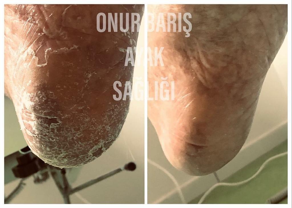 Ayak tabanında yanlış ayakkabı,basış bozuklukları,ortopedik deformasyon ve ağır fiziksel aktiviteler sonucu oluşan kalınlaşma diyabet hastalarında yaralar açılmasına neden olabilir...düzenli medikal bakım ile bu sorunların üstesinden gelebiliriz... #podoloji #podologie #podologia