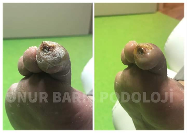 Diyabetik ayakta önemsenmeyen küçük bir nasır sorunu uzuv kaybına neden olabilir.Bu hastamız böyle nedenler ile iki parmağını kaybetmiş,kalanı korumak adına tedavisine başladık... ☺️ #podoloji #podologie #podologia #podolog #ayaksağlığı #medikalayakbakımı #ayaksağlığımerkezi