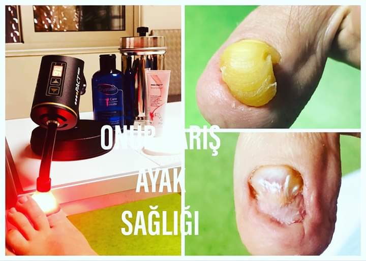 Yıllardır tırnak mantarından muzdarip olan hastamızın bu nedenle üç kez de tırnağı çekilmiş,mantar iyileşmediği gibi tırnak yatağı da bunun sonucunda deforme olmuş.Mikrobiyolojik tırnak kültürünü alarak öncelikle mantarın cinsini tespit edip derhal tedavisine başladık.#trnkmantar