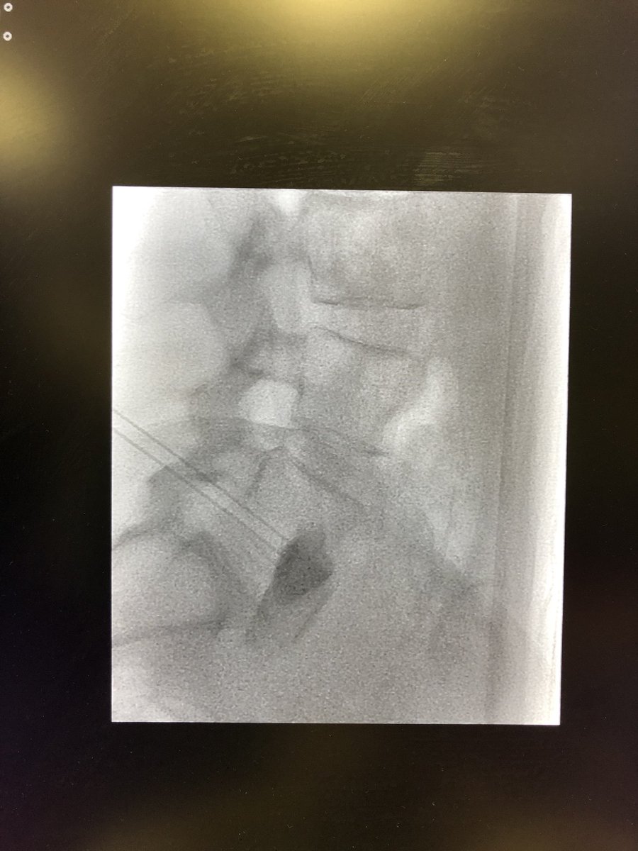 herrero_dr's tweet photo. Superior Hypogastric Block. CIDO (Centro Integral de Dolor Oncológico) #cancerpain #cido #chronicpain #interventionalmanagement @HMHOSPITALES https://t.co/LvxfdYHQvi