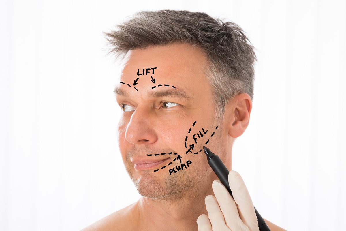 dr_kspence's tweet photo. The chiseled male face- Radiese is a great filler for strengthening the jawline, cheek and temple with no downtime. #maleplasticsurgery #Radiese #Orlando #plasticsurgery #facialfiller https://t.co/uQLT55xaMx
