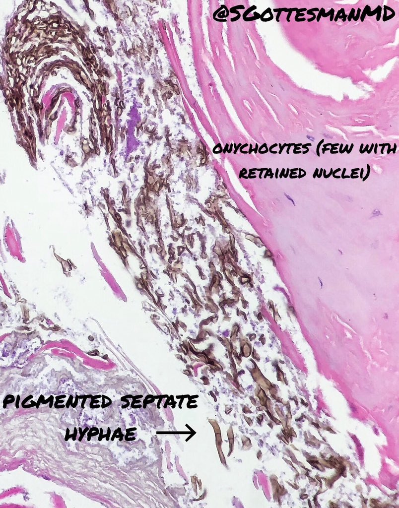 DermpathJC's tweet photo. Longitudinal melanonychia not always secondary to melanotic macule, melanocytic nevus, or melanoma. 
Other causes: medications, infections, trauma, pregnancy, race, endocrine abnormalities. #dermpathJC

Here’s two of my nail cases. 
Left: chromomycosis 
Right: onychomycosis https://t.co/ROr28TBajD
