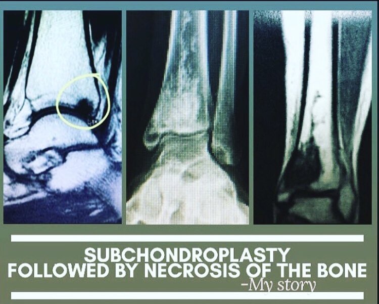 charity96839203's tweet photo. It was hard to fall asleep. I woke up sore and angry. Your bone cement #accufill killed part of my leg. @zimmerbiomet. I read this is being used in people’s spines now!? DONT! What if you kill their spine?!?! Wait until your @clinicaltrials are done!!! #notsafeyet #wearentlabrats https://t.co/1mkGvnMrNb