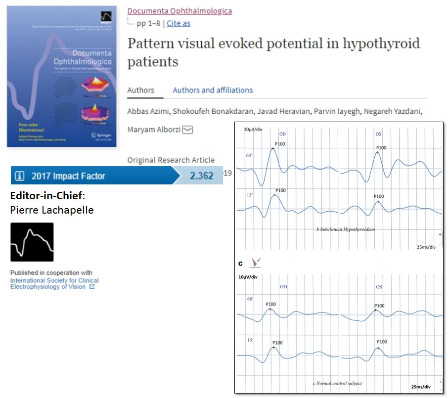 ClinMedJournals's tweet image. DOCUMENTA #OPHTHALMOLOGICA 
Analysis of functional integrity of #visualpathway in #hypothyroid patients: a new diagnostic tool? rdcu.be/bijLW

#VEP #PVEP #Latency #Thyroid #Hypothyroidism #Ophthalmology #electrophysiology #ISCEV @diepbiomed