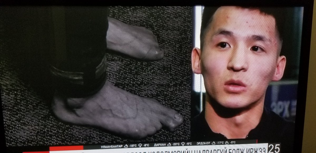 Эвий дээ, айлын хөөрхөн хүү. 10 хурууны 9-г тайруулсан байна.