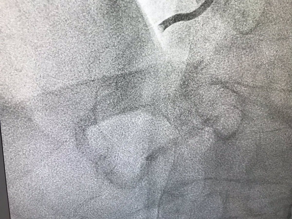 colum_owens's tweet image. #RotaShock case 2. 82 year old male. PCI 2017 LAD and RCA in US. Complex ISR and new disease in RCA. Previous PCI attempt Nov 18 unsuccessful. NSTEMI presentation and subtotal calcified RCA @cghanratty @Almanfi_Cardio @ShockwaveIVL @BSCCardiology @jedicath