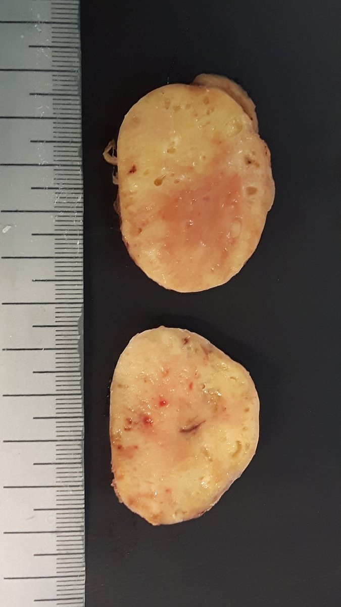  axilar lymph node. When you cut it, translucent & sticky material. Your guess?  #grossognosis  @SEAP_IAP