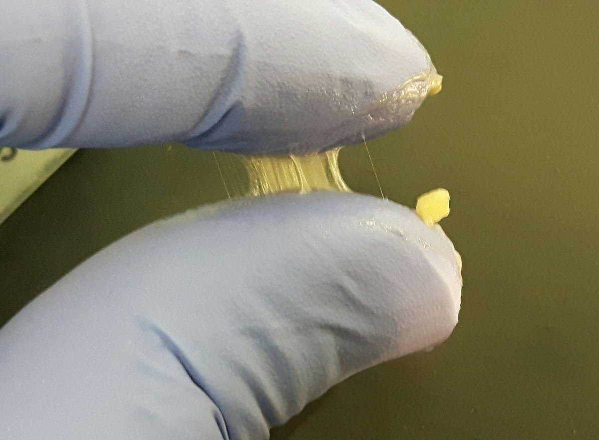  axilar lymph node. When you cut it, translucent & sticky material. Your guess?  #grossognosis  @SEAP_IAP