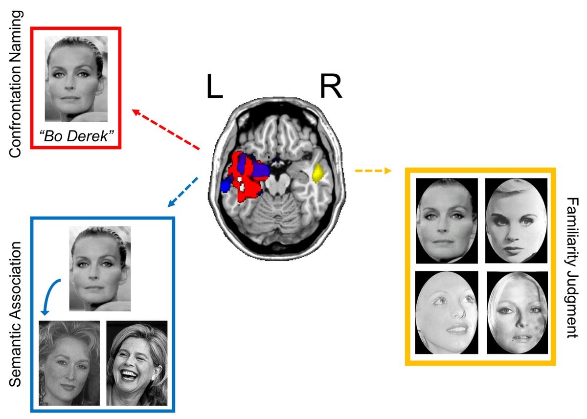 vborghesani's tweet photo. That face…your right ATL is enough to feel like you know her, but you need your left ATL to name her! Our insights on famous #faceprocessing from #neurodegenerative diseases: https://t.co/ATbxujEhpn 
Thanks to @BinneyRJ @GvnBattistella &amp; all brilliant collaborators @UCSFmac https://t.co/NjAaxr18cb