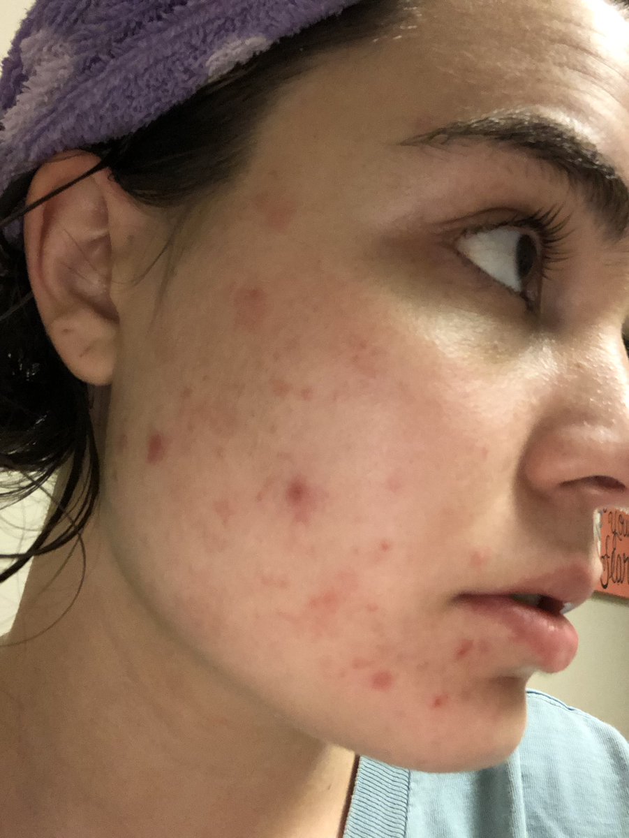 rissaann__'s tweet photo. Girls!!!! If you know me well, you know I’ve dealt with pretty bad acne my entire life. After accutane in the 10th grade, it still returned. I have finally found the only thing that has ever kept my face clear. It does it by balancing hormones. Look @ these pics! @AlaniNutrition https://t.co/m2iWLesLQt