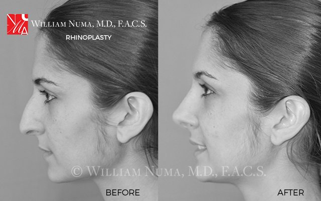 DrWilliamNuma's tweet photo. Benefits patients can experience with a #rhinoplasty procedure:
✔Balance the size, shape of the nose with the face.
✔Correct breathing problems.
✔Repair damage due to injury.
✔Give the face a more youthful, balanced appearance.
✔Enhance confidence and self-image. #BeautyTips https://t.co/OjO8mc6XBy