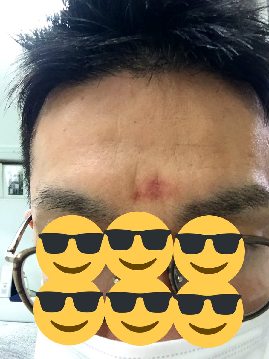 眉間赤いアザ 眉間赤いアザ