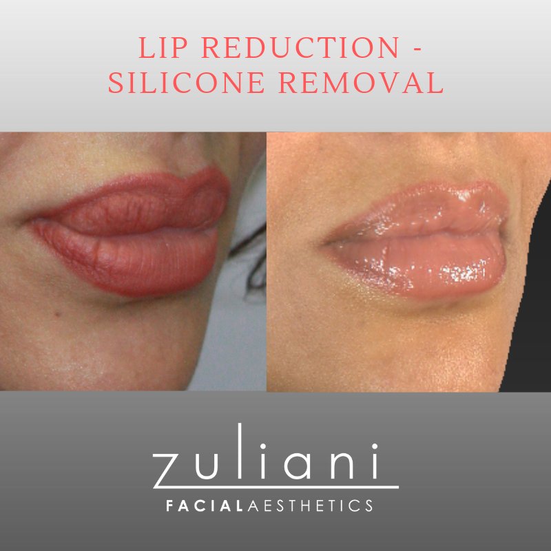 DoctorZuliani's tweet photo. It's #ThankfulThursday and this beautiful patient was beyond grateful that Dr. Z was able to reduce the silicone she had in her lips to give her a more balanced, aesthetically pleasing look.#lipreduction #lips #drzuliani #siliconereduction #facedoc #zfa #zulianifacialaesthetics https://t.co/9UUUUvXvC4