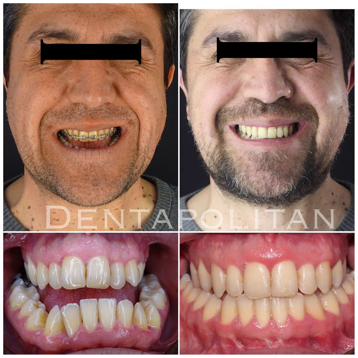 Dentapolitan's tweet image. 💫Piezo Surgery Çift Çene Ortognatik Cerrahi Vakamız

👉 Ortodonti ve Cerrahi Planlama @OguzOztoprak 
👉 Maksillofasyal Cerrahi Doç.Dr. Mustafa Tek

#piezosurgery #openbitejawsurgery #ortognatikcerrahi #ortognatik #çenecerrahisi #ortodonti #cene #çiftçene #ameliyat #çeneameliyatı
