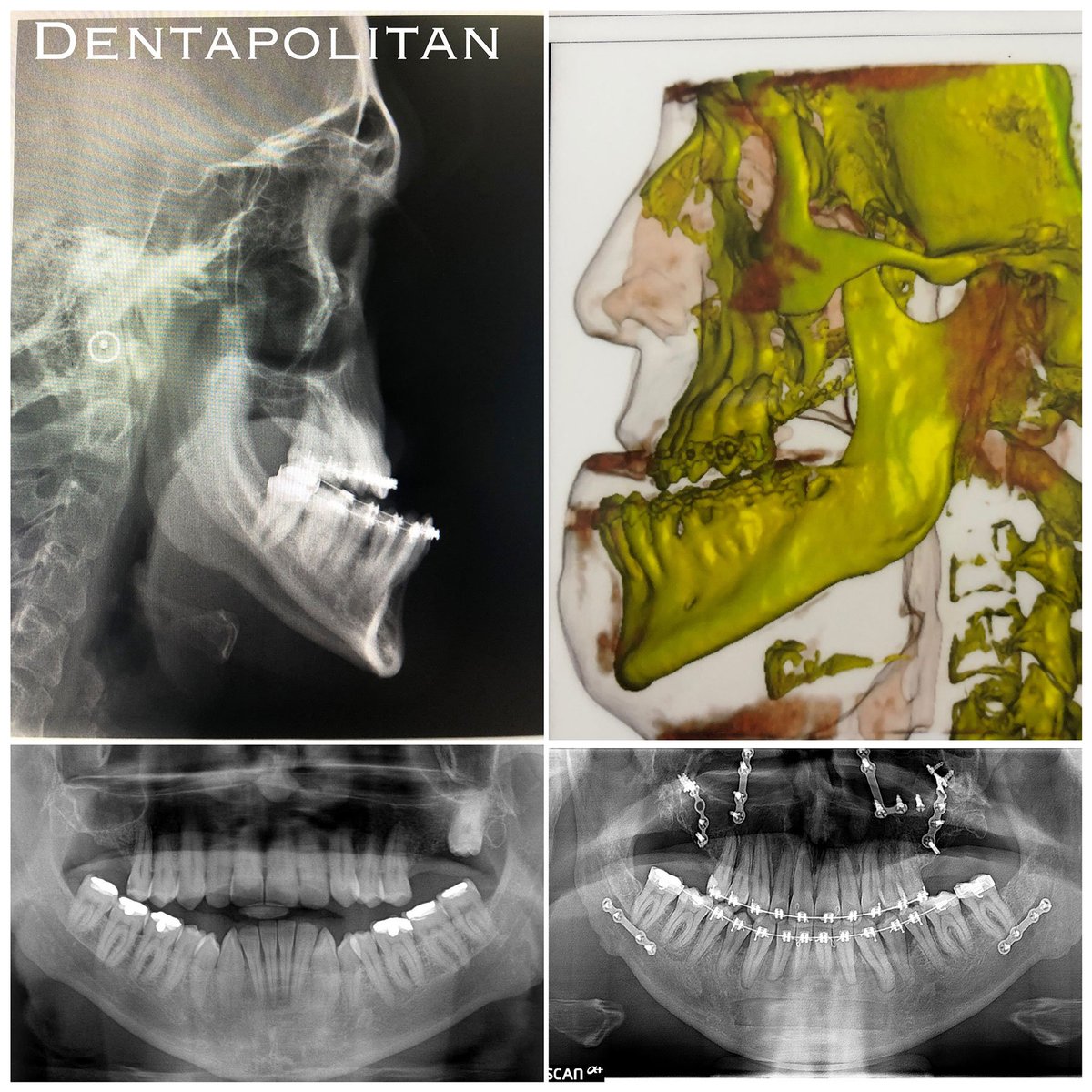 Dentapolitan's tweet image. 💫Piezo Surgery Çift Çene Ortognatik Cerrahi Vakamız

👉 Ortodonti ve Cerrahi Planlama @OguzOztoprak 
👉 Maksillofasyal Cerrahi Doç.Dr. Mustafa Tek

#piezosurgery #openbitejawsurgery #ortognatikcerrahi #ortognatik #çenecerrahisi #ortodonti #cene #çiftçene #ameliyat #çeneameliyatı