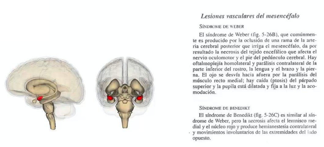 vic_pallares's tweet photo. #CuriosidadesDeLaMedicina

Año 1889.- Moritz Benedikt, pionero d la #neurología clínica, describe el #síndrome que lleva su nombre (apoyado por JM Charcot) en 3 pacientes con #tuberculomas. De los 1º en hablar d la #neurastenia masculina. Poco reconocido en su época.

@SEMERGENap https://t.co/3s4gPvc54G