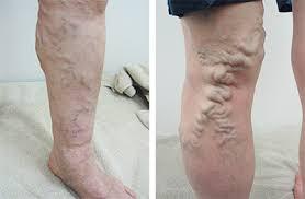 Sorriso در توییتر 世界一受けたい授業で 立ちっぱなしだと下肢静脈瘤っていうのになるって言ってる 座りっぱなしでもダメらしい 足 がかゆいとかむくみっていうのも症状っていうから見てるけどおそろしい 血流よくしろって話 Sorriso در توییتر 世界一受けたい授業で 立ちっぱなしだと下肢静脈瘤っていうのになるって言ってる 座りっぱなしでもダメらしい 足 がかゆいとかむくみっていうのも症状っていうから見てるけどおそろしい 血流よくしろって話