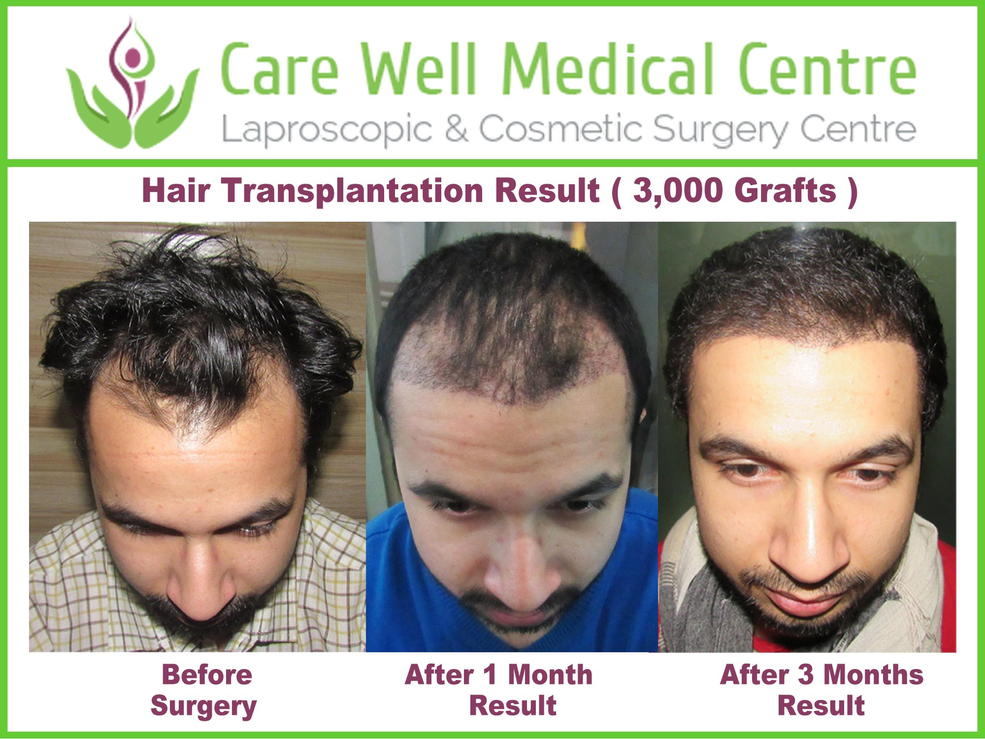 Hair transplant patient review cost photos pictures feedbacks