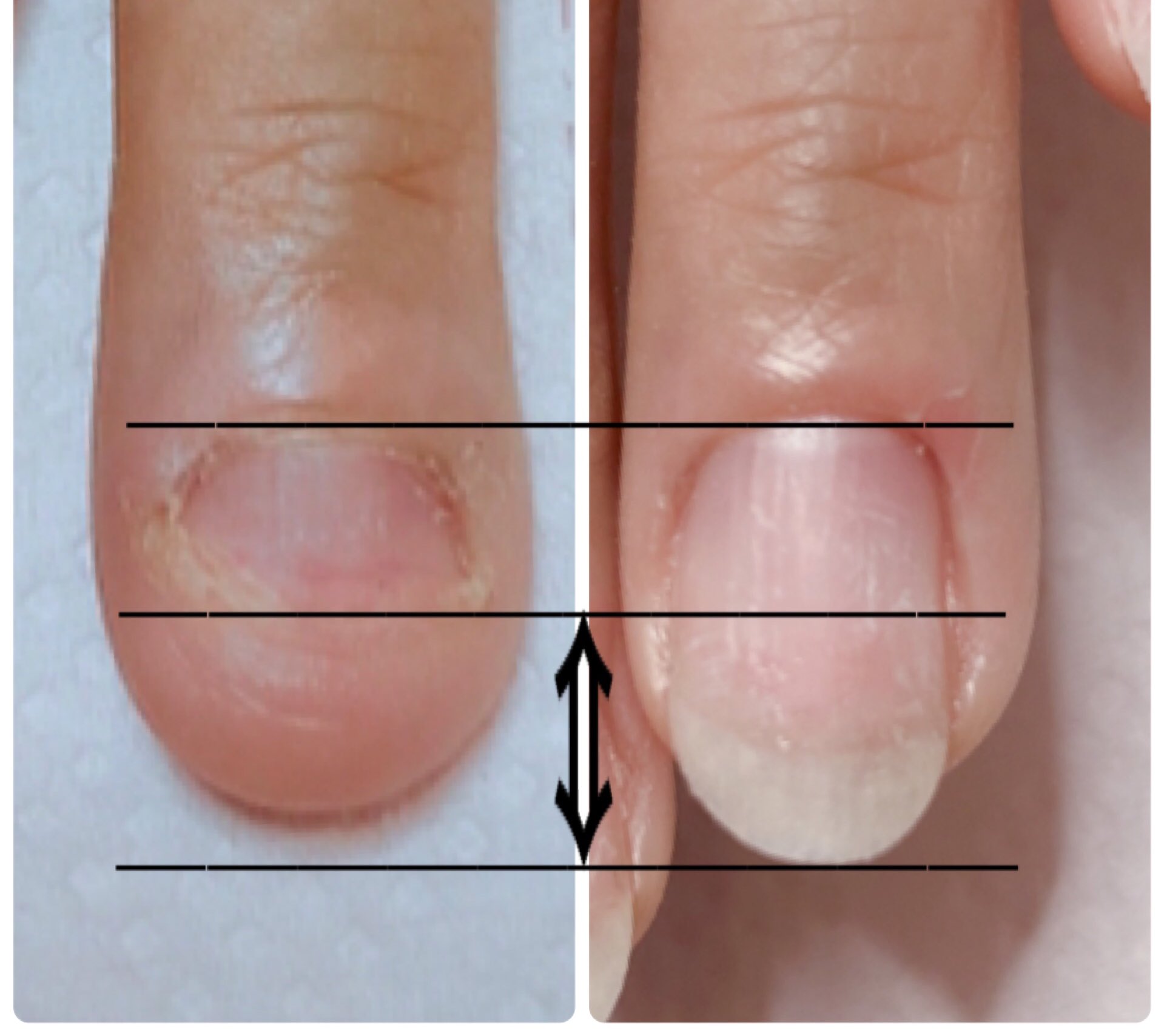 茨木市深爪矯正ネイルサロンスマイルニコ Mhtsalon Twitter