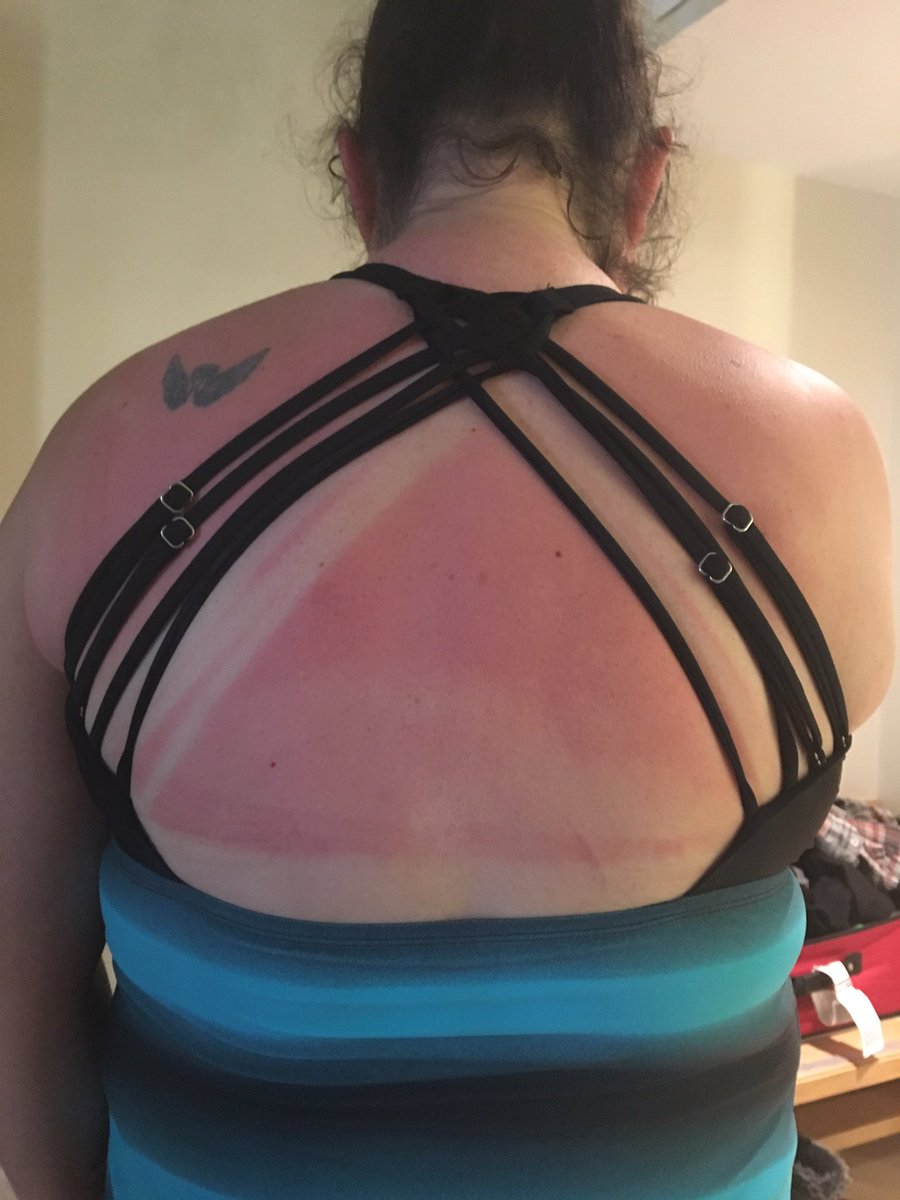 AHaddow's tweet photo. Ouch. #Sunburn #PuntaCana #SaonaIsland #TheSunIsHot https://t.co/8EEJg9QGm3