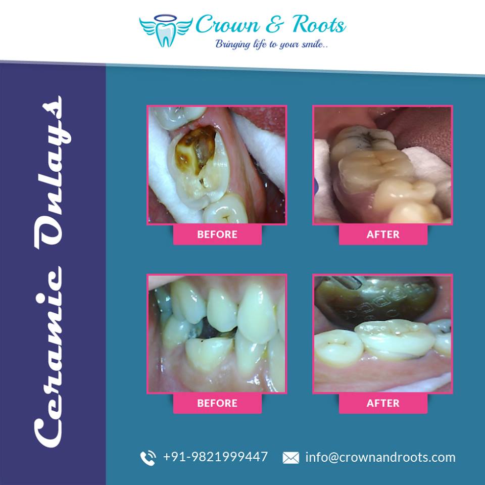 crownandroots's tweet photo. Case For Ceramic Onlays

"Smile, It's Free Therapy"

#CrownAndRoots 😀#smile #CeramicOnlays #bestdentalclinicinSouthDelhi #dentistinSouthDelhi 👨‍🔬 #DrKartikDatta 👩‍🔬 #DrMansiDatta https://t.co/VGaEZpqR8d