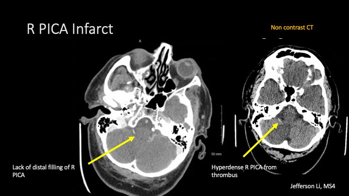 LilyWangDr's tweet photo. Great MS4 #neurorad case presentation. A well-known and commonly taught imaging sign in an unusual location. @UCRadRes https://t.co/GgYadv8tTb