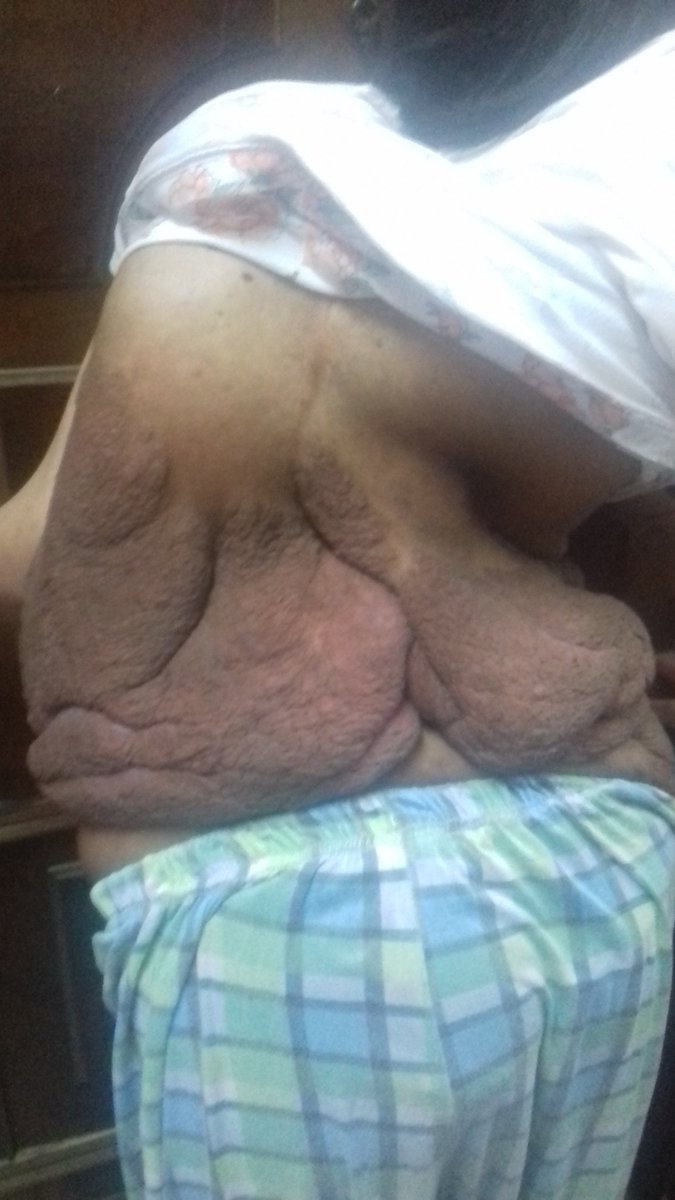 GhadaRa98's tweet photo. انا غادة مريضة بمرض neurofibromatosis للأسف ملوش علاج بمصر لصعوبة الحالة والعلاج متواجد بالدول المتقدمة طبيا المرض اثر على العمود الفقرى والجلد وتم استغلال حالتى بالاعلام والصحافة والمسؤولين ومحدش ساعد فى النهاية
محتاجين الدعم منكم عشان اسافر
#انقذوا_غادة
#ياسر_إبراهيم https://t.co/OlqPF2rLJR