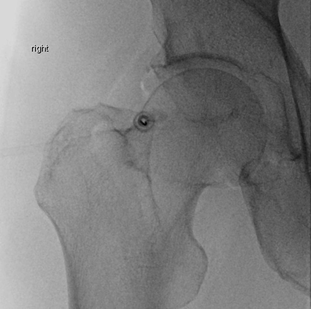 DanielWessellMD's tweet photo. Flouro guided joint injection on patients with iodinated contrast allergy? No problem. A little air works great to confirm intra articular needle placement. #MSKrad https://t.co/L77GY12r57