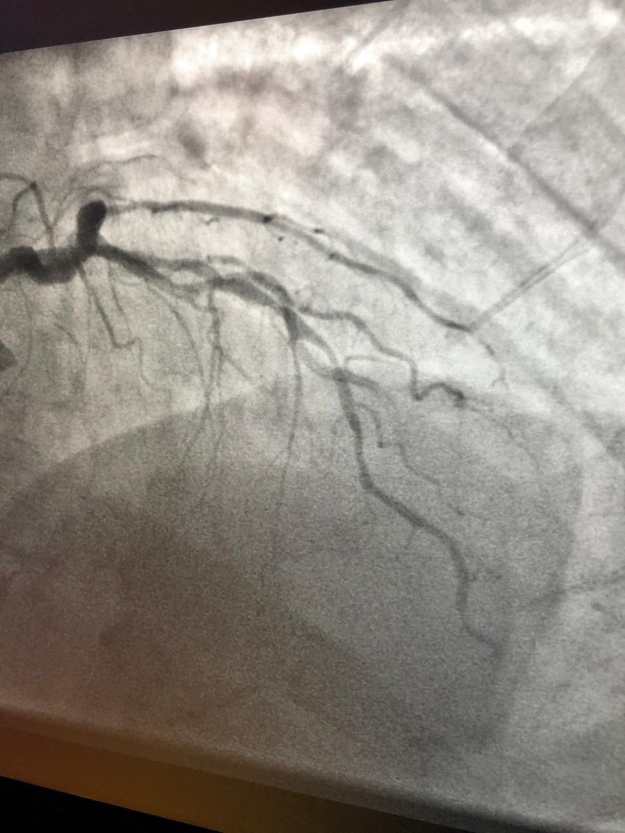 M3Medical's tweet photo. Another great result with @ShockwaveIVL  @ULHospitals  with Prof. Kiernan. IVL wouldn’t initially track. Little Rota followed by IVL 3.0 and image tells it all.
#fixingbrokenhearts #IVL #shockwave #M3 #cardiology #solutionsthroughpartnership https://t.co/vkaU1CUJuv