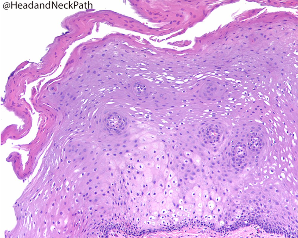 tobacco pouch keratosis histology 3: Frictional Keratosis, Contact Keratosis and Smokeless Tobacco Keratosis:  Features of Reactive White Lesions of the Oral Mucosa by Susan Müller:  https://t.co/2OhxXwgldE #HeadNeckPathol #HNPJ #HeadandNeckPath #Pathology  #ENTPath #PathologyTweet