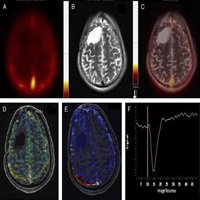 Current Issue: Differentiation of Recurrent/Residual Glioma From Radiation Necrosis Using Semi Quantitative 99mTc MDM (Bis-Methionine-DTPA) Brain SPECT/CT and Dynamic Susceptibility Contrast-Enhanced MR Perfusion: A Comparative Study dlvr.it/QxkGLY
