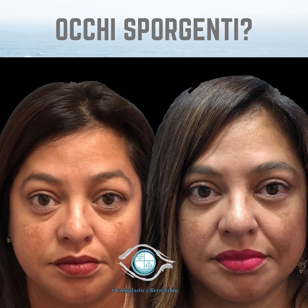 Occhi Sporgenti? Le cause sono molteplici e vanno dalla costituzionalità, l’invecchiamento o alterazioni della tiroide. Si manifestano con una visibilità della sclera (il bianco dell’occhio) tra l’occhio stesso e la palpebra inferiore ...

🔗 oculoplasticabernardini.it/3750-esoftalmo…

📞 010312331