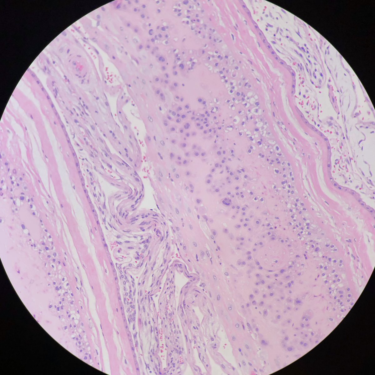 lindasongMD's tweet photo. The happiest decidua I’ve ever seen! Can you spot the happy cell? #placentapath #pathologistshavefun https://t.co/JaS39QIjMD