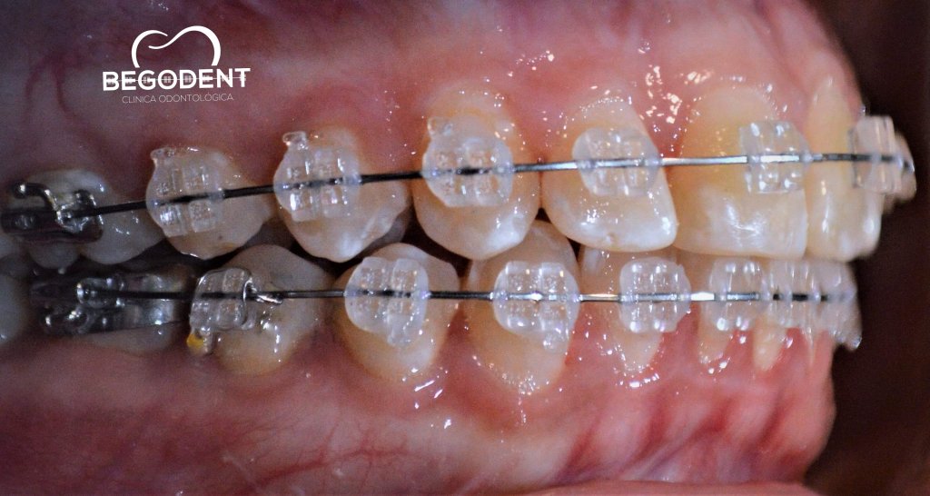 BegoDentCO's tweet photo. De todo lo que llevas puesto lo único que no pasa de moda es tu 🆂🅾🅽🆁🅸🆂🅰 

Consulta para iniciar tu tratamiento de Ortodoncia:
🔸️ Brackets Metálicos 
🔸️ Brackets Cerámicos 
🔸️ Brackets Zafiro
🔸️ Brackets Autoligados
🔸️ Linguales
🔸️ Invisibles https://t.co/eRyZKbAOwu