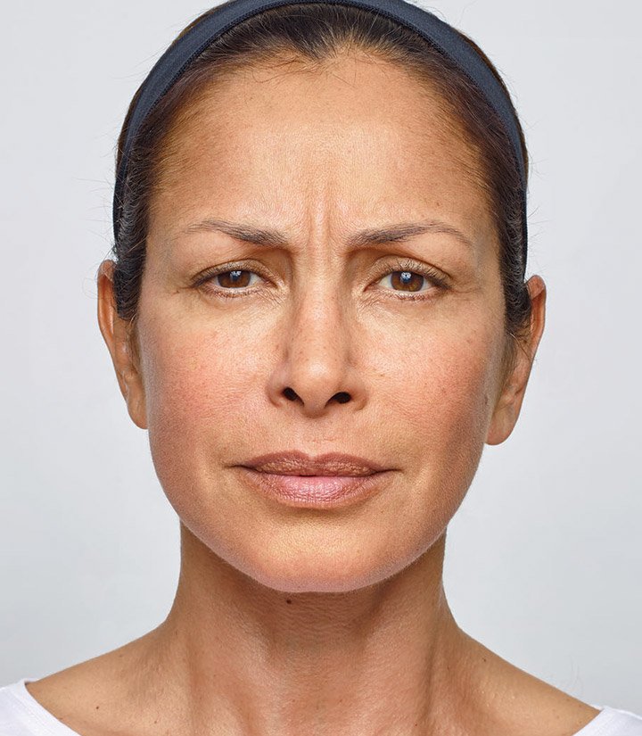 межбровная морщина. межбровная морщина. межбровная морщина. морщинки на лбу. межбровная морщина ботокс.