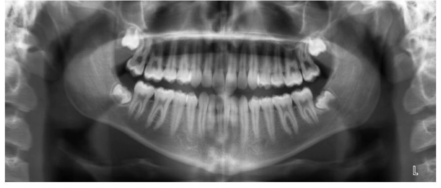 DS_Ortho's tweet photo. Complete Clinical Orthodontics Case File: 14 Year Old Author: Dr. Raffaele Spena Click to view the case on our blog at https://t.co/GsjBvZvAFc #CCOSystem https://t.co/7STsl95CtY