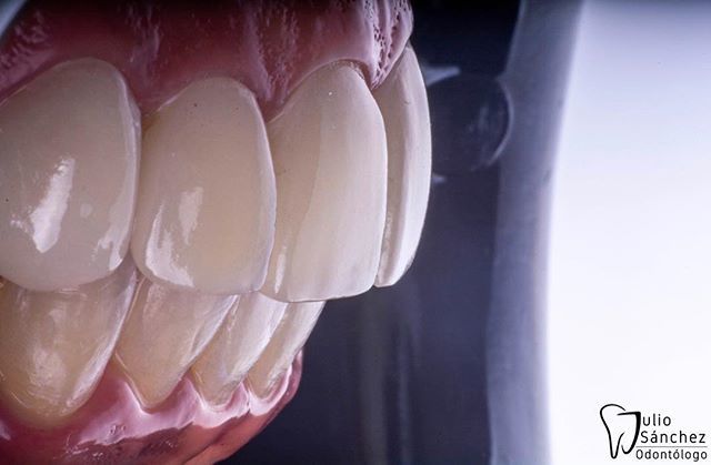 julioucvod's tweet image. Laminados cerámicos, siempre buscando la naturaleza que es la real Estetica! Gracias a mi TPD y hermano @lab_brident por su excelente trabajo 👍🏻 #veeners #Venezuela #odontologia #dentalimplants #carillasdentales bit.ly/2MCleBS