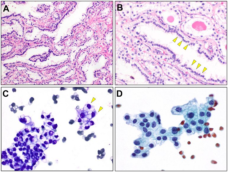 CancerCytopath's tweet photo. New entities, new technologies, new findings: A review of the cytologic features of recently established subtypes of #RenalCellCarcinoma https://t.co/0VLMg9rJVc https://t.co/2A0vgX4E2a