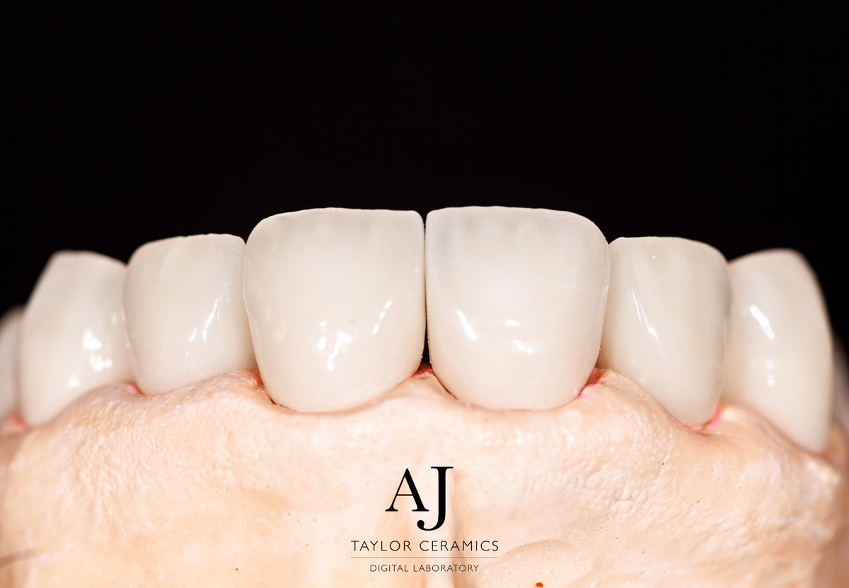 Mini makeover using @IvoclarUK #emax #crowns #digitaldentistry #cardiff #newport