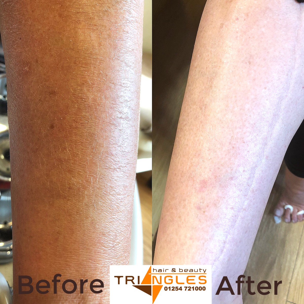 Triangles4's tweet image. Concerned with your skin?? 🤔🤔

These before and after pictures show the results of our @Environskincare A, C &amp;amp; E body oil for 2 weeks! Goodbye dry flakey skin! Hellooo soft silky legs 

Start your skin journey on the 6th of Feb at our skin event feat Visa Skin Analysis machine