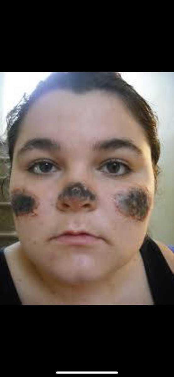 MsKristaRae's tweet photo. #closeosu I certainly don’t want frost bite. You already have my money so why do you not want to cancel class? Should your students be forced to bare these marks just to receive a grade? Show us you care! https://t.co/OBGFtGT3ad