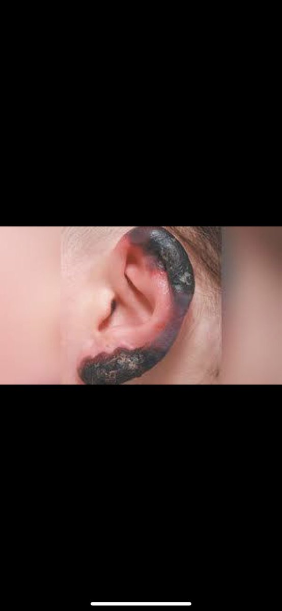 MsKristaRae's tweet photo. #closeosu I certainly don’t want frost bite. You already have my money so why do you not want to cancel class? Should your students be forced to bare these marks just to receive a grade? Show us you care! https://t.co/OBGFtGT3ad
