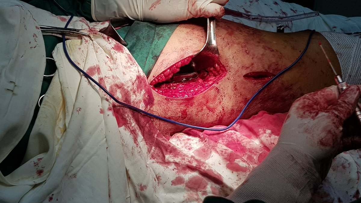 VinceLenardSTan's tweet photo. #partialhipreplacement https://t.co/vD3ijbMJKY