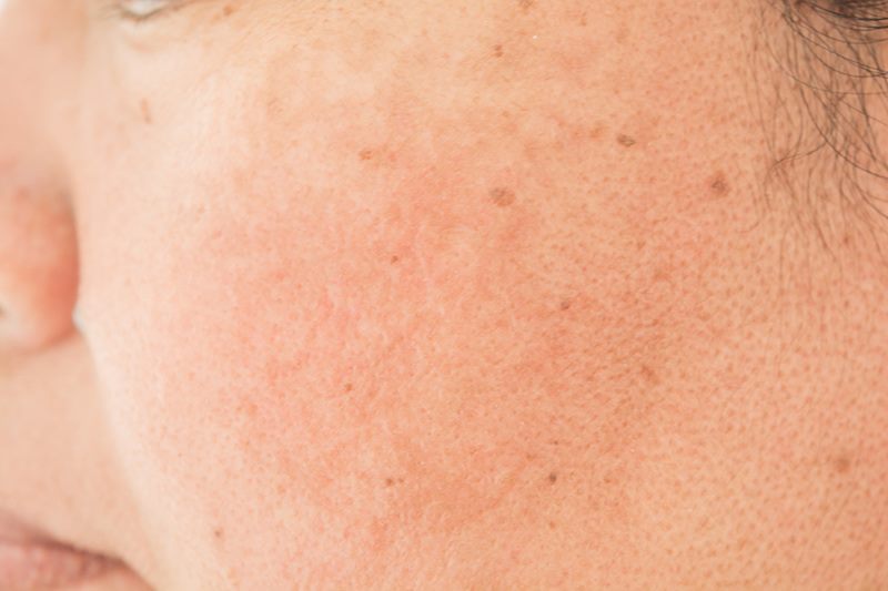 Did You Know?
Rosacea is a common skin condition affecting more than 14 million and tends to be more common in those with a history of bad acne. Learn more about #Rosacea treatment Acworth Dermatology:
acworthderm.com/rosacea.html