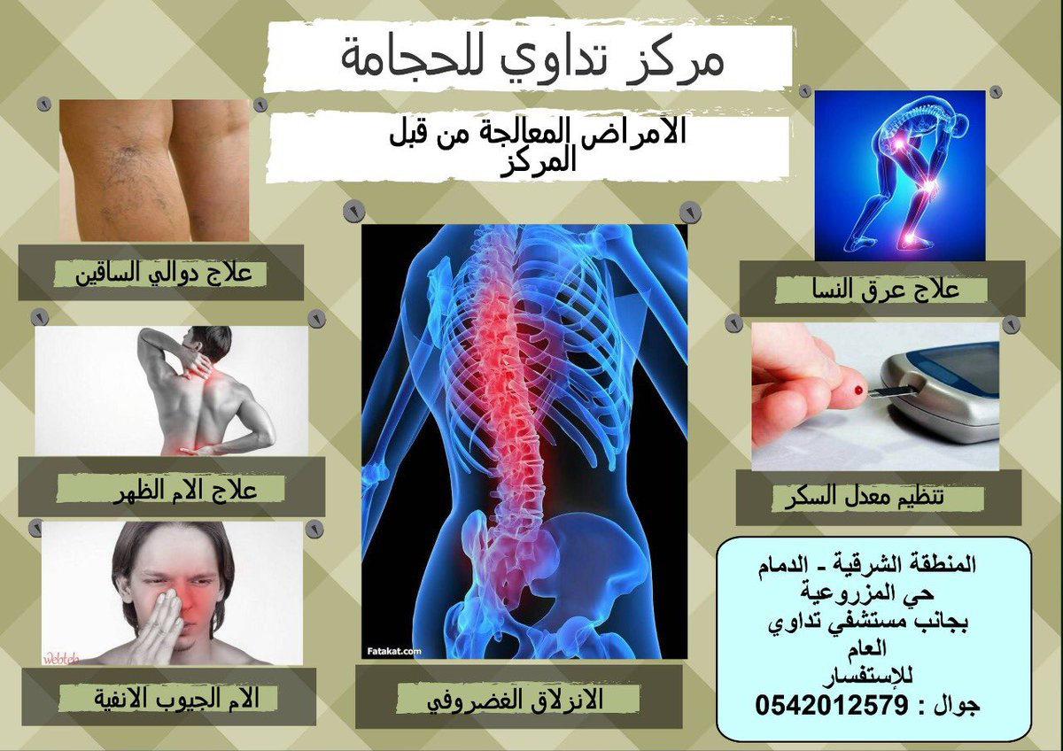 علاج عرق النسا بالحجامة