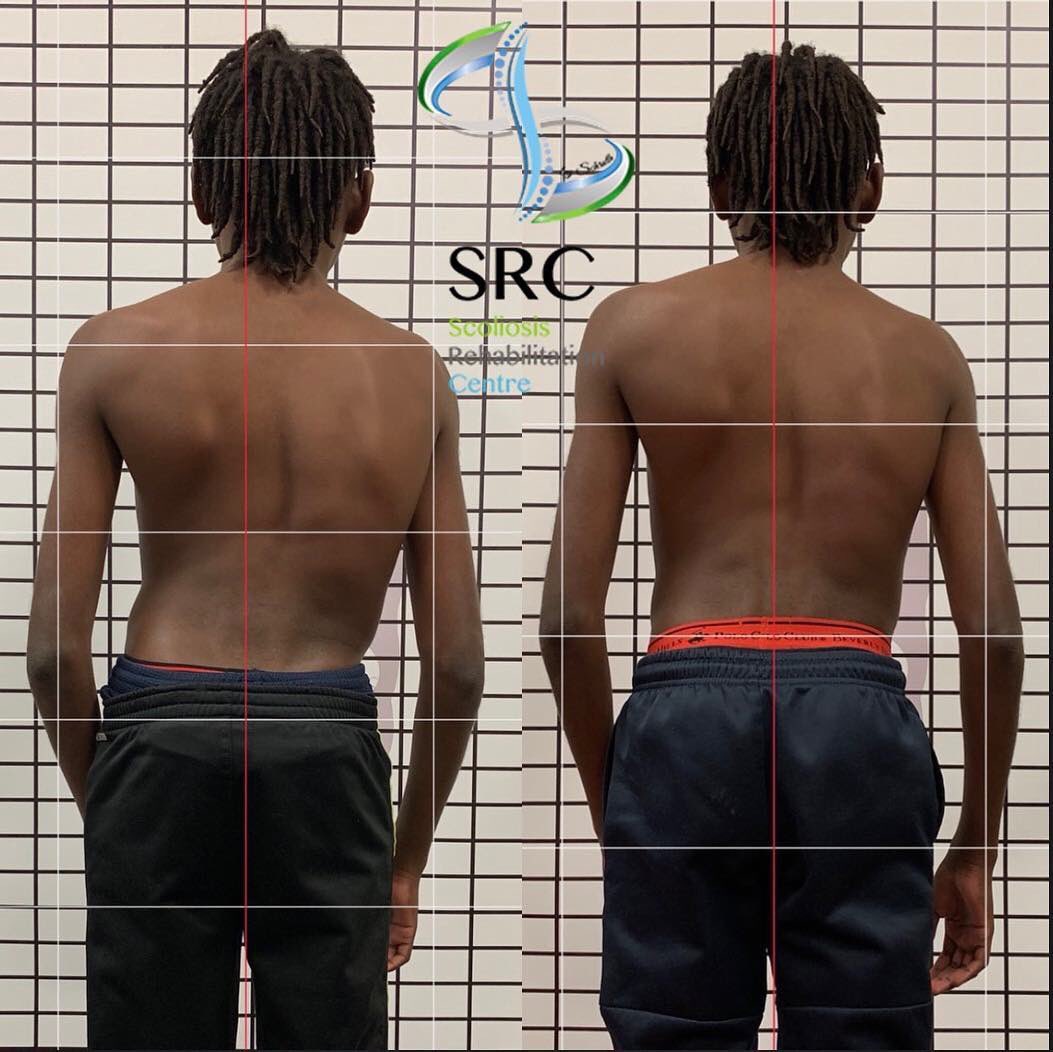 ScolioCentar's tweet image. Naši rezultati sa kampa iz Amerike! Uporan i naporan rad uvek da rezultat! Prijave za sledeću Schroth edukaciju su krenule, a prvi seo edukacije će biti odrzan od 10.04.2019.-14.04.2019. #schrothmethod #schrot #scoliocentar #scoliosisawareness #spine #isstschroth #scoliosis